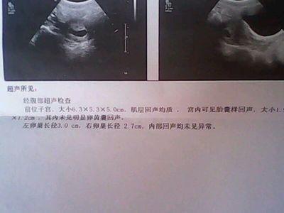 正常的胎心监护图 正常胎心的表现