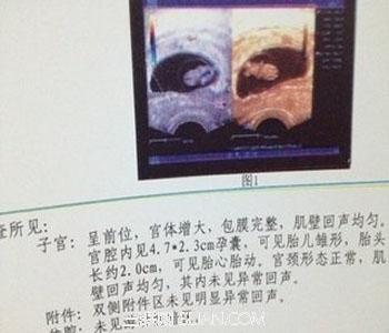 孕囊与孕周不符危害 孕囊大小与孕周不符怎么办好