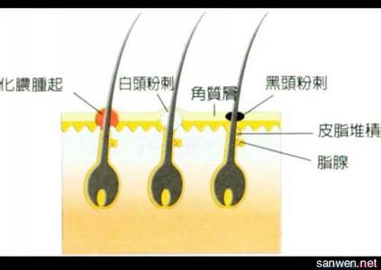 鼻炎的原因有哪些 鼻炎形成的原因