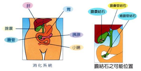 胆结石饮食注意事项 胆结石是如何形成的 胆结石饮食需要注意什么