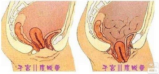 子宫脱垂的症状 子宫脱垂有什么症状 子宫脱垂的症状介绍
