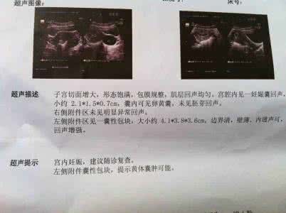 孕囊在子宫位置正常图 孕囊会在子宫里移动吗