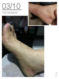 皮肤脚癣手藓怎么治 脚癣是怎样形成的_脚藓的形成原因