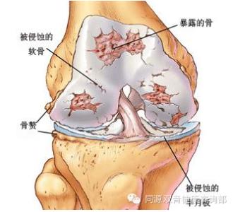 类风湿产生的原因 类风湿形成的原因