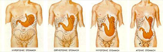 胃下垂最佳治疗方法 胃下垂是怎么引起的