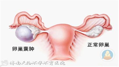 卵巢囊肿的病因 卵巢囊肿形成的病因