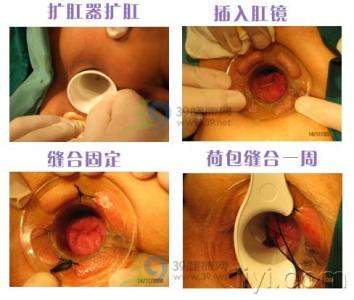 痔疮手术后吃什么食物 痔疮手术后吃什么好_痔疮手术后宜吃的食物