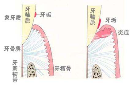 如何清除牙垢 牙垢是如何形成的 牙垢的预防和清除