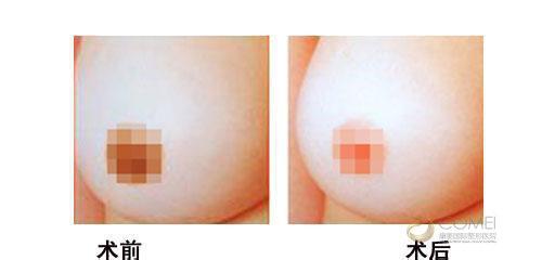 女性健康：乳头有缺陷怎么办？