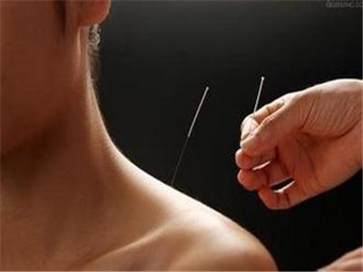 偏头痛针灸治疗方法 各类头痛的针灸治疗方法