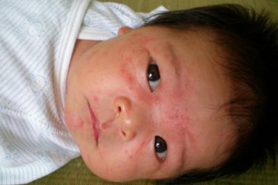 婴儿湿疹最佳治疗方法 婴儿湿疹怎么治疗