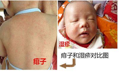如何区分痱子和湿疹 如何区分婴儿湿疹与痱子