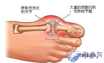 痛风症状的早期表现 痛风病人不能吃什么