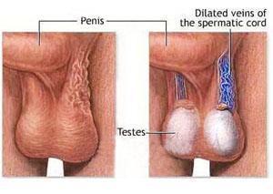 阴囊下垂是什么原因 关于什么是阴囊下垂