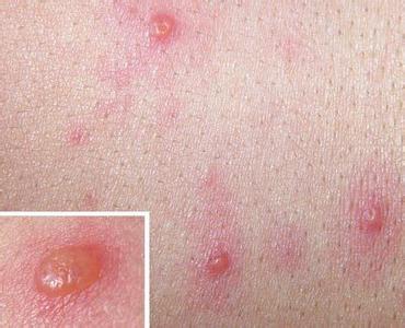 水痘是怎么引起的 为什么会长水痘