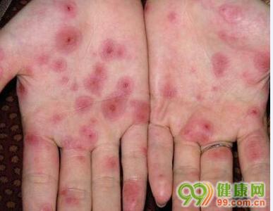 水痘和手足口病的区别 怎么区分水痘与手足口病