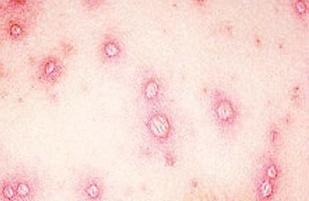 大人出水痘有什么症状 出水痘有哪些症状