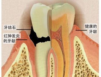 牙结石怎么去除 牙结石要怎么去除