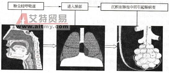 怎样治疗尘肺病 尘肺病是怎样形成的