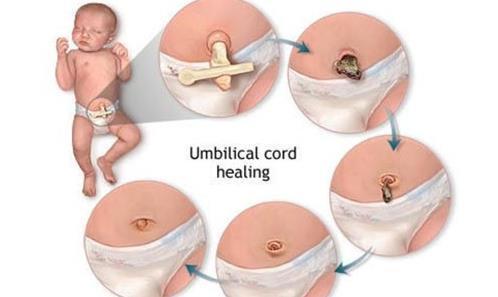 新生儿脐带怎么护理 新生儿脐带护理的三原则五细节