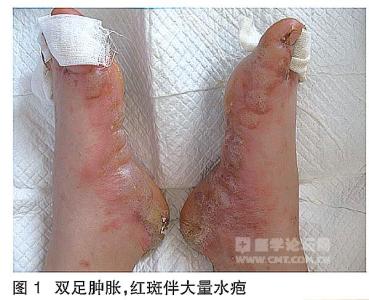 手足癣怎么形成的 足癣是怎么形成的 怎么治疗足癣