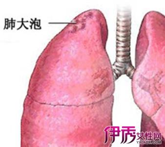 肺大泡是怎么形成的 肺大泡是怎么形成的 怎么治疗肺大泡