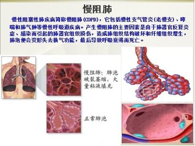 肺纤维化怎么治疗 肺纤维化形成的原因 怎么治疗肺纤维化