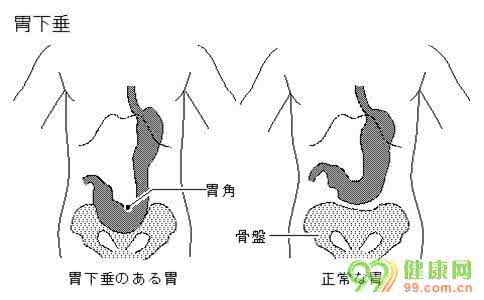 胃下垂怎么形成的 胃下垂怎么形成的 治疗胃下垂食疗方