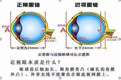 近视眼是怎样形成的 近视眼是怎么样形成的
