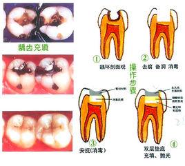 如何预防龋齿 龋齿是怎样形成的 如何预防龋齿的形成
