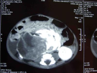 卵巢畸胎瘤形成原因 畸胎瘤形成的原因 畸胎瘤如何治疗