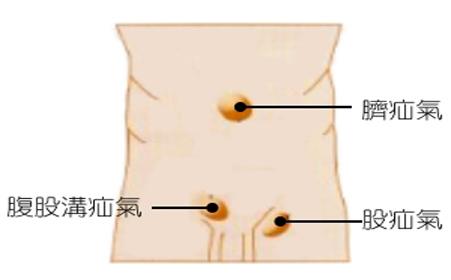 疝气的病因 疝气形成的病因