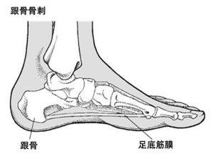 足跟骨刺的症状 足跟骨刺是怎么形成的