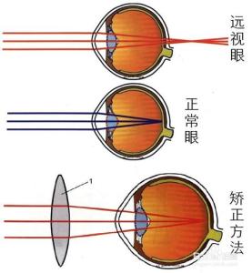 近视形成的原理图 近视形成的原理