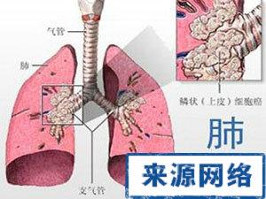 肺癌怎么检查出来 肺癌怎么形成的