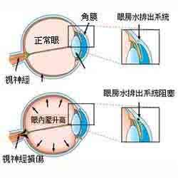 得了青光眼怎么办 青光眼是怎么形成的