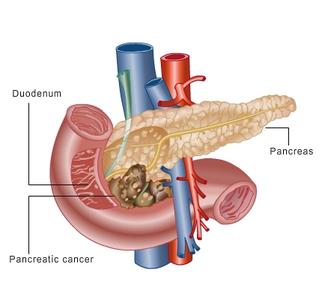 胰腺癌是怎样形成的 胰腺癌形成的原因