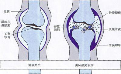 类风湿病症 类风湿怎么形成的 类风湿有哪些病症