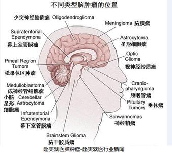 脑肿瘤原因 脑肿瘤是怎么形成的_脑肿瘤的原因