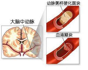 颈部血栓 颈部血栓是怎样形成的