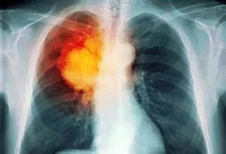 肺癌的前兆是什么 肺癌有什么前兆 肺癌的前兆