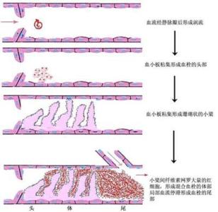 血栓的形成的过程 血栓如何形成的