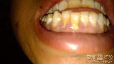 牙龈萎缩如何治疗 如何有效治疗牙龈萎缩