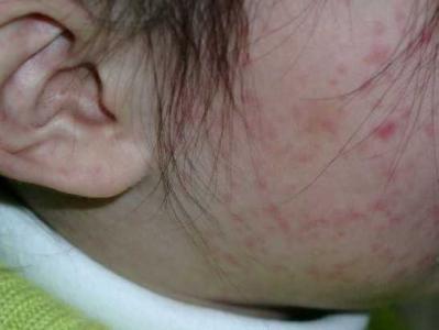 荨麻疹早期症状 麻疹的早期症状表现