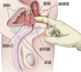 广州前列腺保健养生馆 前列腺如何养生保健
