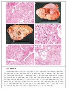 肾钙化怎么治疗 肾钙化的症状有哪些 肾钙化治疗护理方法