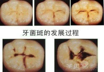 牙菌斑的形成 牙菌斑形成的三个阶段