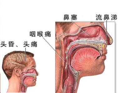 鼻炎是怎么形成的 鼻炎时吐出来的痰是什么形成的