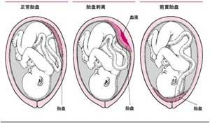 胎盘低怎么回事 胎盘低究竟是怎么回事呢？