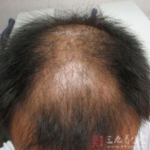 治疗掉头发的土方法 治疗掉头发的方法有哪些